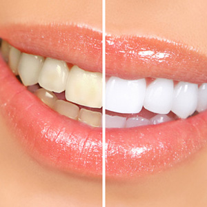 Before & After Whitening